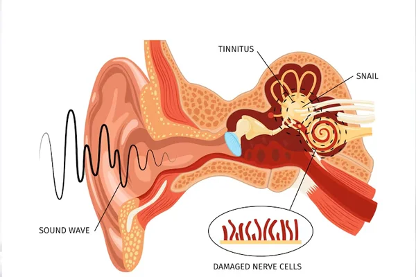 Tinnitus Treatment